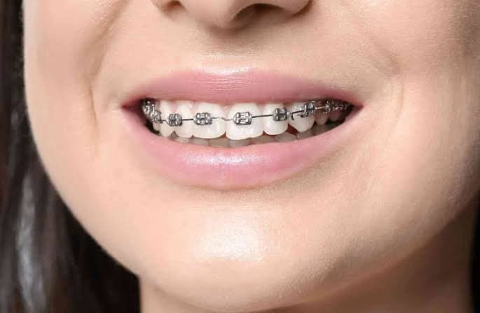 Behel Fashion, Trend atau Berisiko?