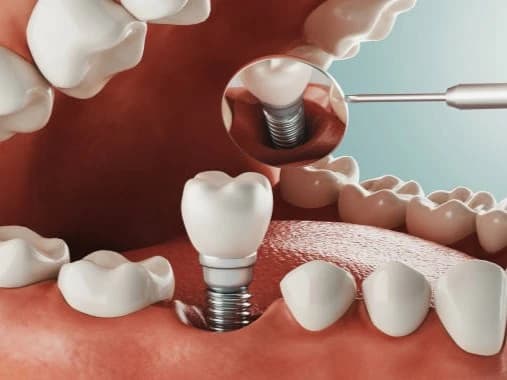 Implant